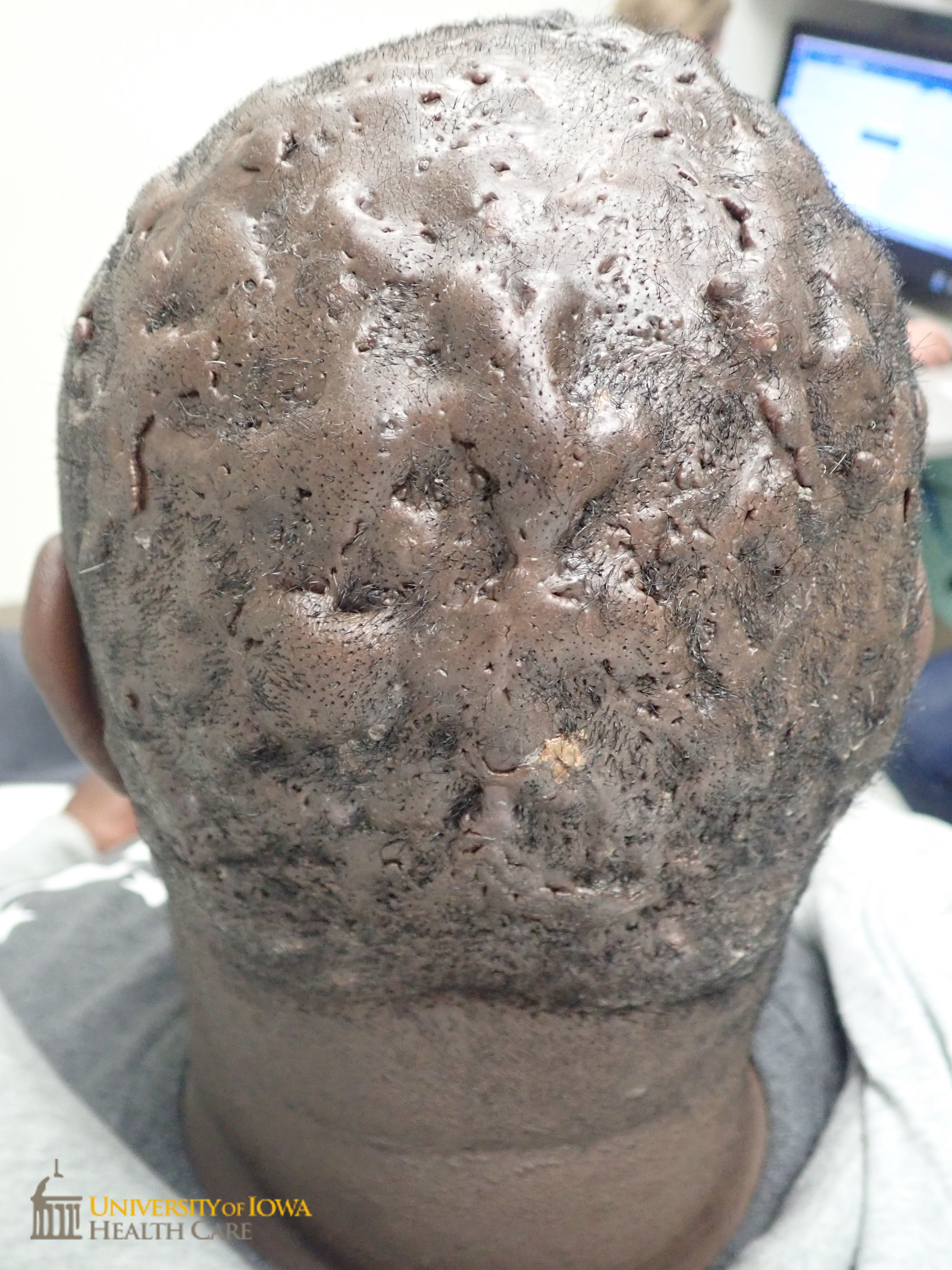 Confluent keloidal plaques with overlying scaring alopecia on the occipital scalp. (click images for higher resolution).